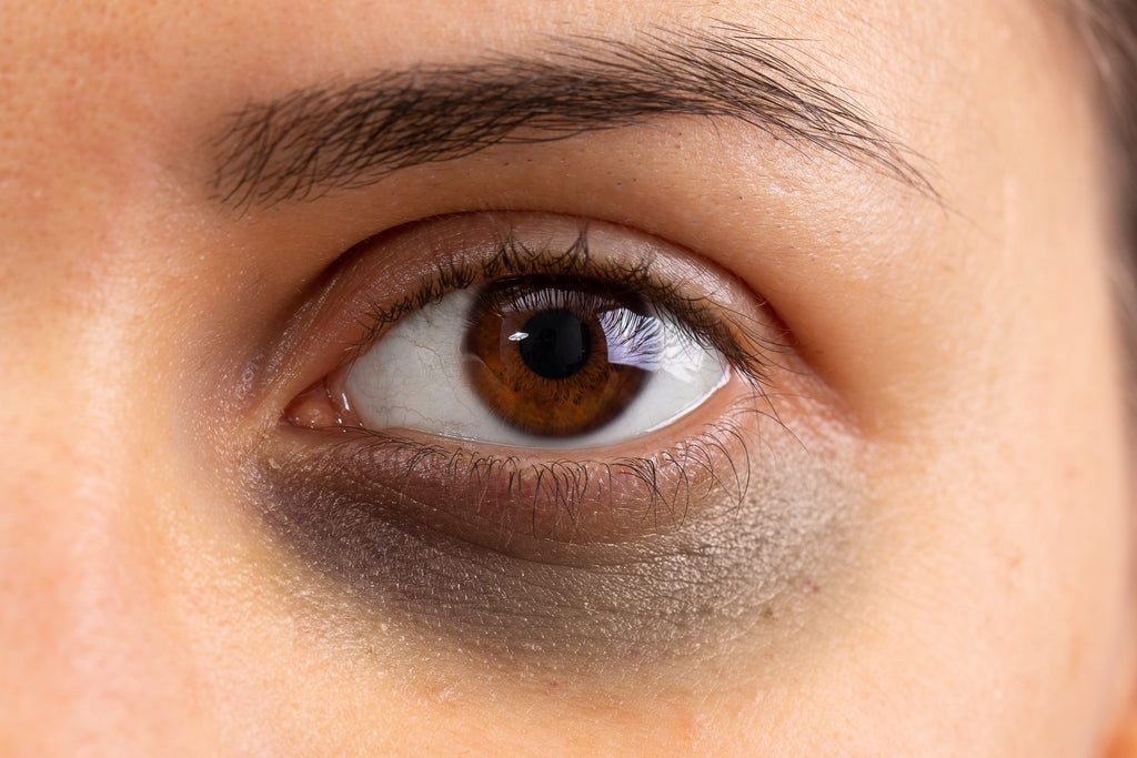 Dark Eye Circles and Its Causes